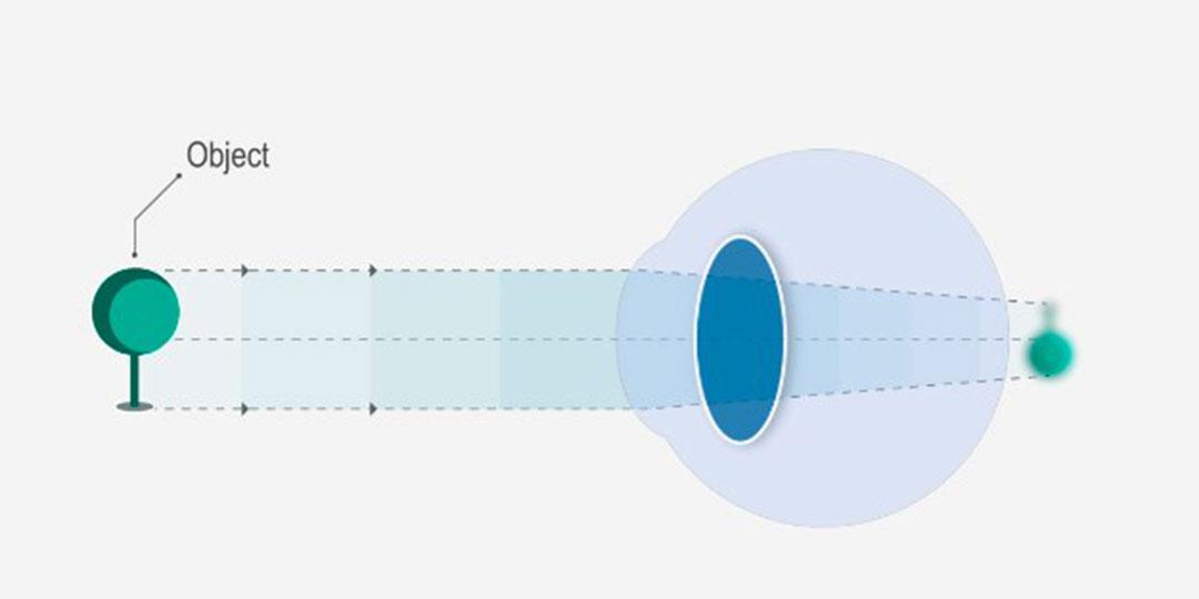 Rejtett hiperlátás mi ez, Hogyan lehet kijavítani a hiperópiát